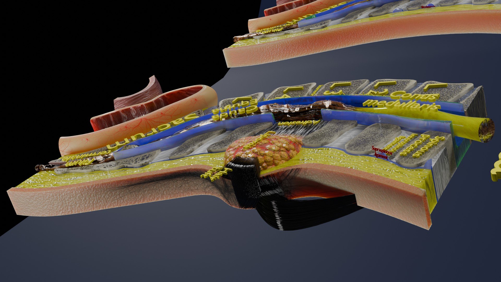 Spina bifida Neural Tube Defect 3D model https://p.turbosquid.com/ts-thumb/pi/sa5DPR/fQ/aa0024/jpg/1742531847/1920x1080/fit_q87/98437d20bc286a6c6946a09deb2405ff58643385/aa0024.jpg