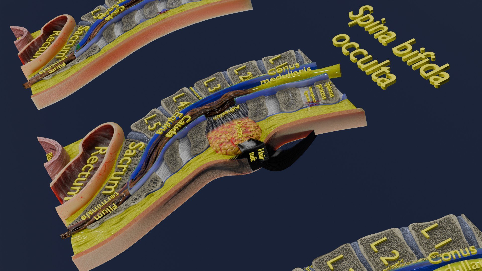 Spina bifida Neural Tube Defect 3D model https://p.turbosquid.com/ts-thumb/pi/sa5DPR/iZ/aa0023/jpg/1742531845/1920x1080/fit_q87/4028e27a7a9b3c4c644e2602aa2e413b8d8668e8/aa0023.jpg