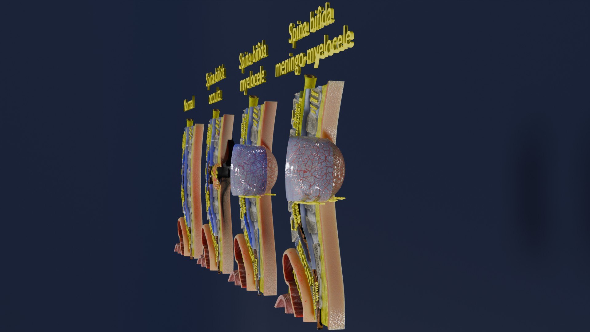 Spina bifida Neural Tube Defect 3D model https://p.turbosquid.com/ts-thumb/pi/sa5DPR/kE/aa0008/jpg/1742531808/1920x1080/fit_q87/1f316f68062d90f0b2e4194146763d4a3c79682e/aa0008.jpg
