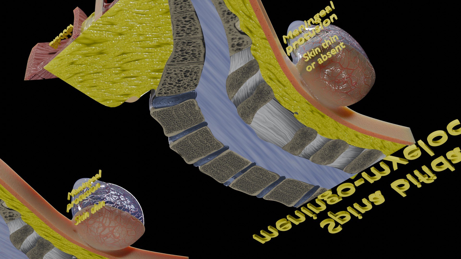 Spina bifida Neural Tube Defect 3D model https://p.turbosquid.com/ts-thumb/pi/sa5DPR/mJ/aa0070/jpg/1742531968/1920x1080/fit_q87/4addba1695383c6e2a9319c79b979ed38988ab30/aa0070.jpg