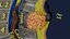 Spina bifida, anomalie du tube neural