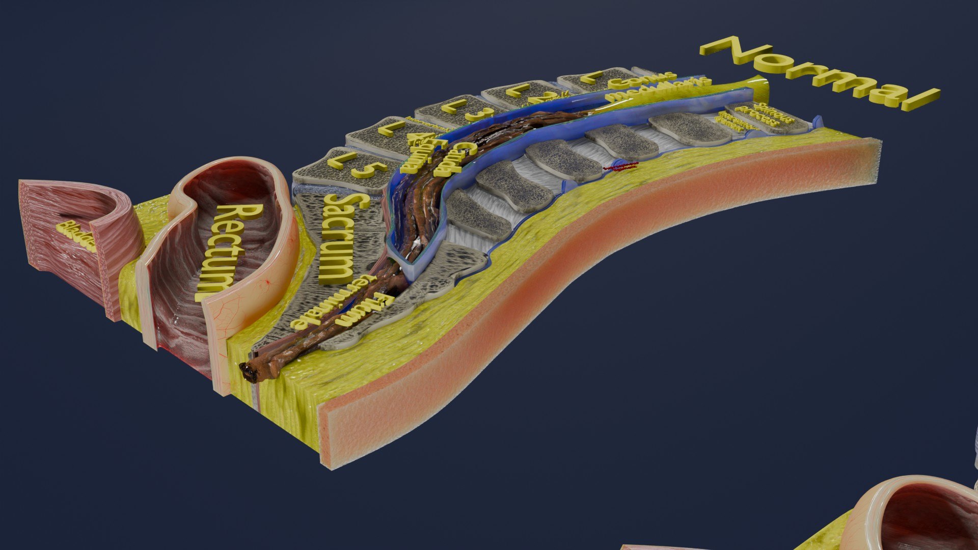 Spina bifida Neural Tube Defect 3D model https://p.turbosquid.com/ts-thumb/pi/sa5DPR/tI/aa0009/jpg/1742531813/1920x1080/fit_q87/55b75429cec723bddcbaed388026dfb57981080e/aa0009.jpg