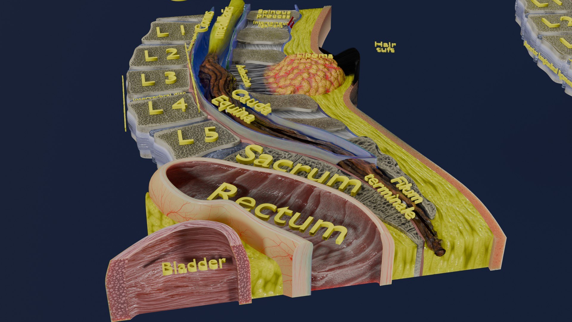 Spina bifida Neural Tube Defect 3D model https://p.turbosquid.com/ts-thumb/pi/sa5DPR/uZ/aa0025/jpg/1742531851/1920x1080/fit_q87/36409720b1d1c925dc747c6f08685384b1e0e2c5/aa0025.jpg