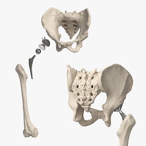 Hip Joint Implant with Pelvic Bone and Femur model