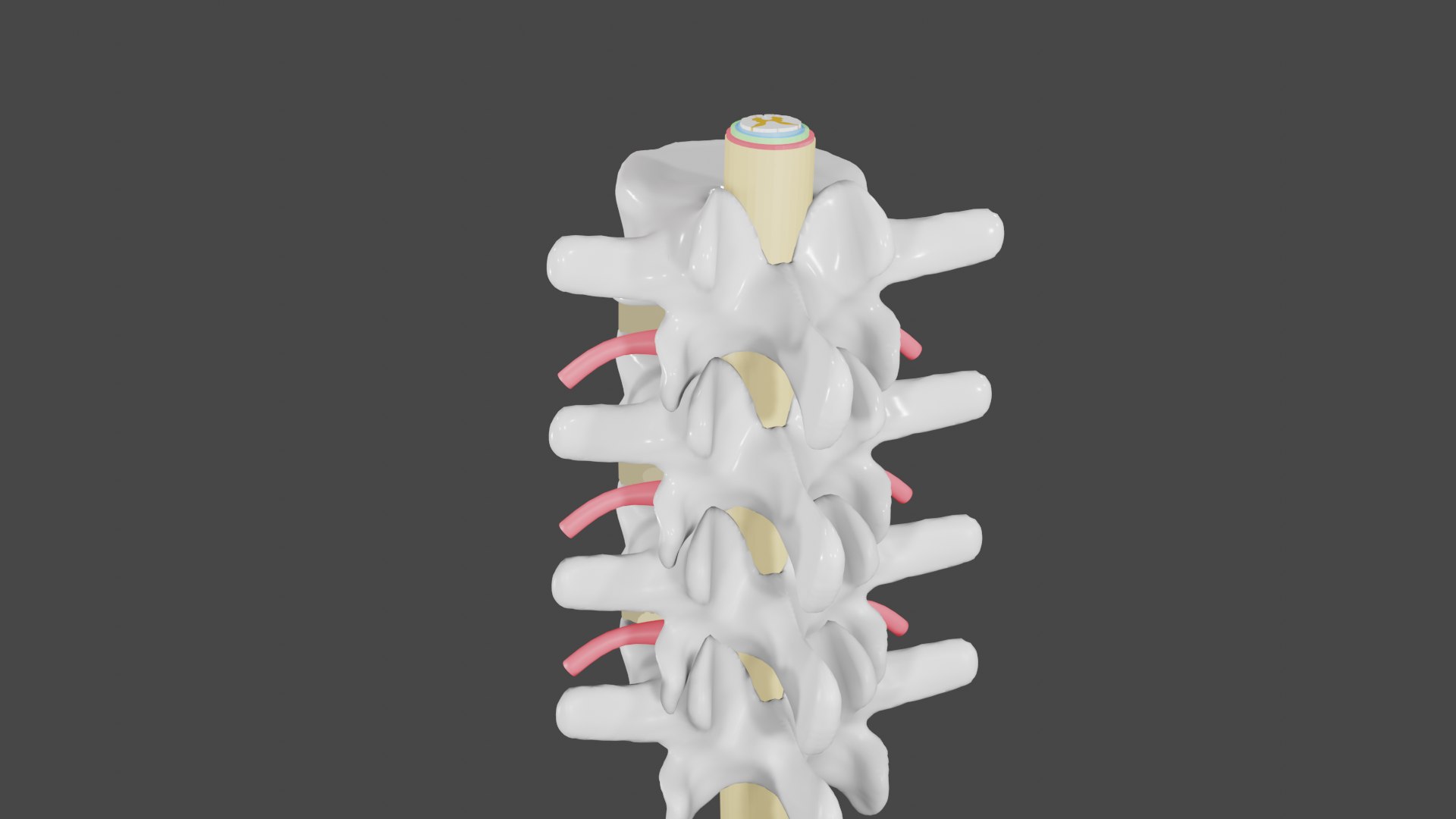 Protrusion Slipped Disc Herniated Model - TurboSquid 1572177