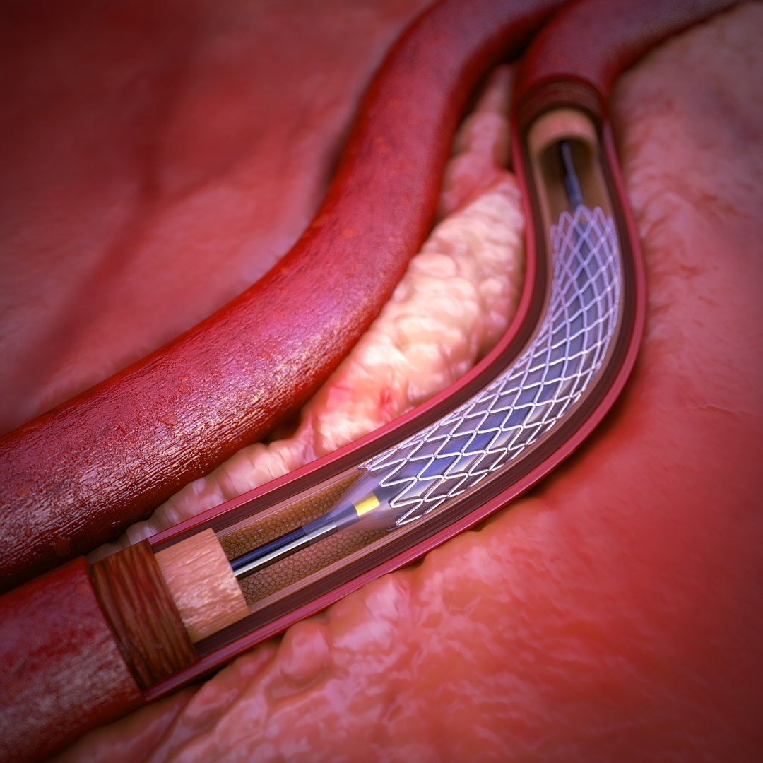 Coronary Artery Stent 3d Max