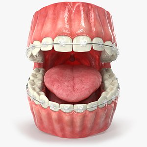 Human Mouth With Self Ligating Transparent Dental Braces V01