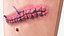 Skin with Medical Seam Open
