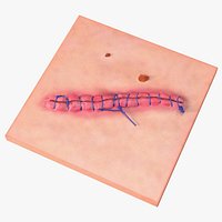 Skin with Medical Seam Open