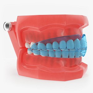 typodont transparent removable retainer 3D