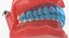 typodont transparent removable retainer 3D