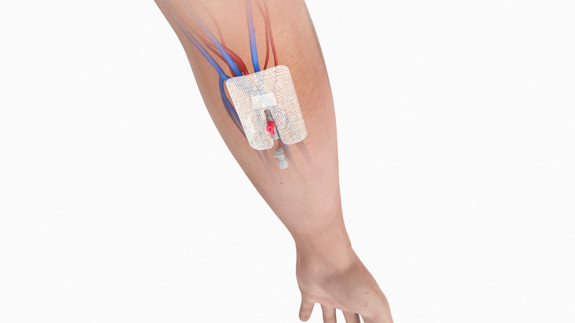 Upper limb Injected Cannula with sticky plaster 3D https://p.turbosquid.com/ts-thumb/qc/nWU4KQ/A6/stickyplastercannula_arm_06/jpg/1674209875/1920x1080/fit_q87/ced1c15783d388a8db279436ff76c5626463a214/stickyplastercannula_arm_06.jpg