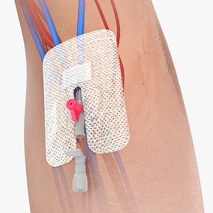 Upper limb Injected Cannula with sticky plaster 3D