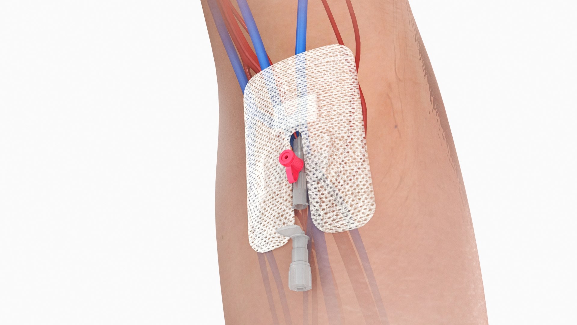 Upper limb Injected Cannula with sticky plaster 3D https://p.turbosquid.com/ts-thumb/qc/nWU4KQ/Pf/stickyplastercannula_arm_01/jpg/1674209871/1920x1080/fit_q87/a777d59ecfc636b0f45d20154087e94b1c1f2407/stickyplastercannula_arm_01.jpg