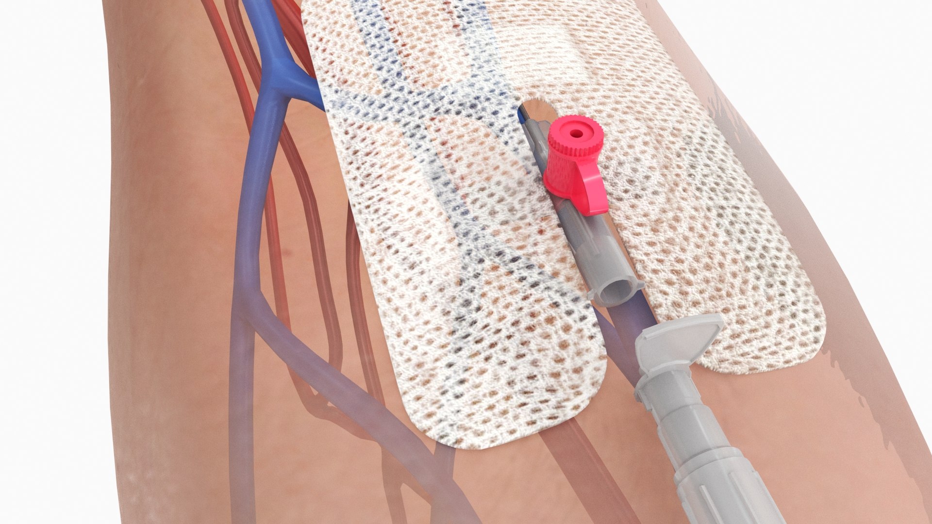 Upper limb Injected Cannula with sticky plaster 3D https://p.turbosquid.com/ts-thumb/qc/nWU4KQ/WA/stickyplastercannula_arm_09/jpg/1674209879/1920x1080/fit_q87/2c3d227e057fd608eafd87c7b986eba5ba0a66f4/stickyplastercannula_arm_09.jpg