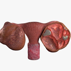 Ovary tumor benign non-cancerous serous cystadenoma