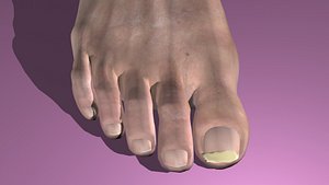Onchomycosis Nail Fungus