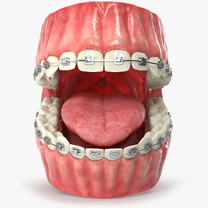 Human Mouth With Self Ligating Steel Dental Braces V02