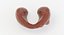 Follicular Cancer Thyroid