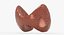 Follicular Cancer Thyroid