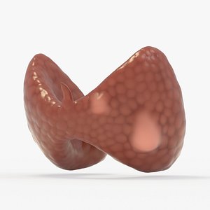 Follicular Cancer Thyroid
