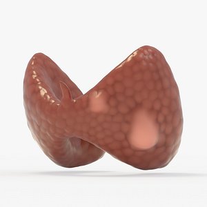 Follicular Cancer Thyroid