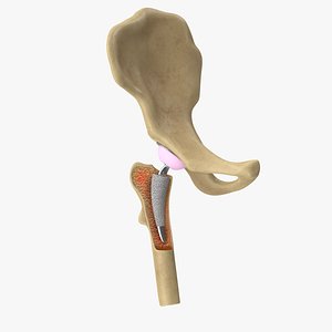 3D Hip Bone Replacement Surgery V01