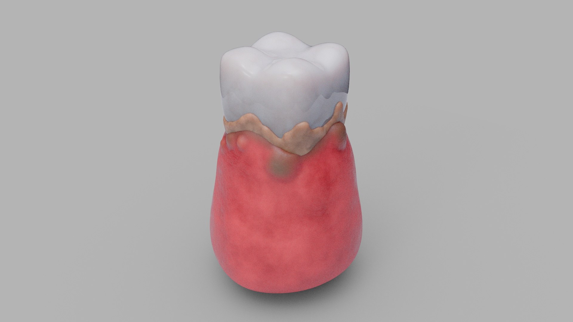 Gum Swelling And Pain Teeth Gums 3D Model - TurboSquid 2641663