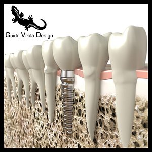 dental implant 3d 3ds