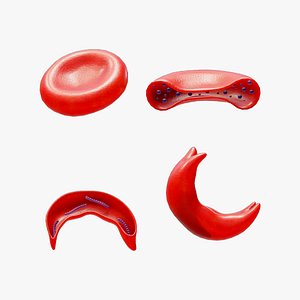 Cross Section of Normal vs Sickle Red Blood Cell