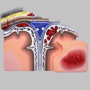 Brain hemorrhage types