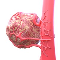 Vessel Tumor