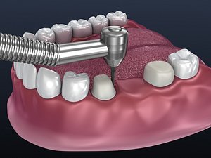 Tooth supported fixed bridge and single crown. Animated process