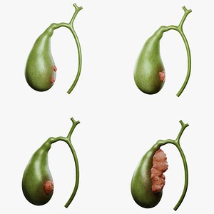 Gallbladder Cancer Progression Stages Anatomy