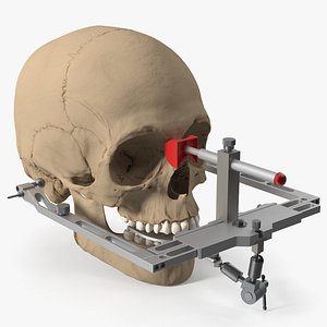 Dental Facebow Assembly on Skull