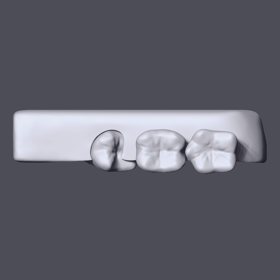 3D Wisdom Impaction Tooth - TurboSquid 1471461