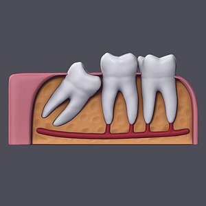 3D wisdom impaction tooth