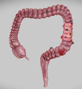 3D disease diverticulosis diverticulitis intestinal