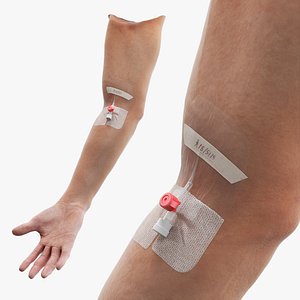 Venous Access Device with Forearm Fixation