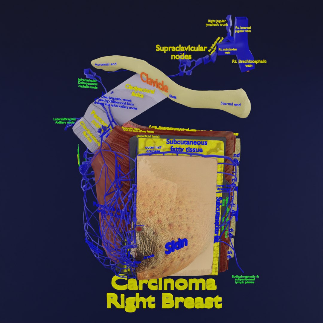 3D Breast Cancer Sketchfab Model - TurboSquid 2055853