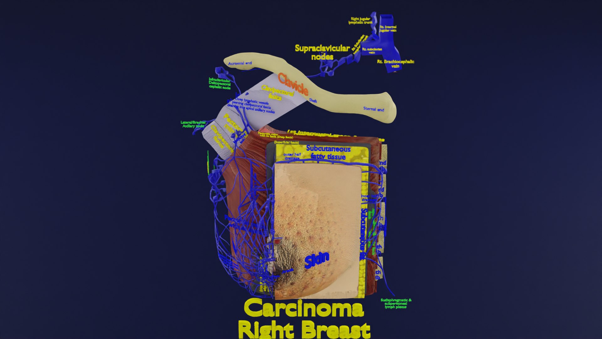 3D Breast Cancer Sketchfab Model - TurboSquid 2055853