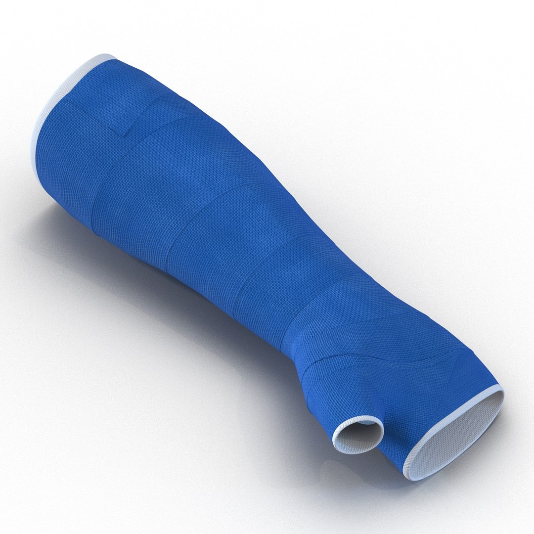 3d blue fiberglass cast arm