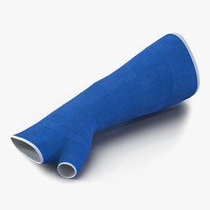 Blue Fiberglass Cast Arm
