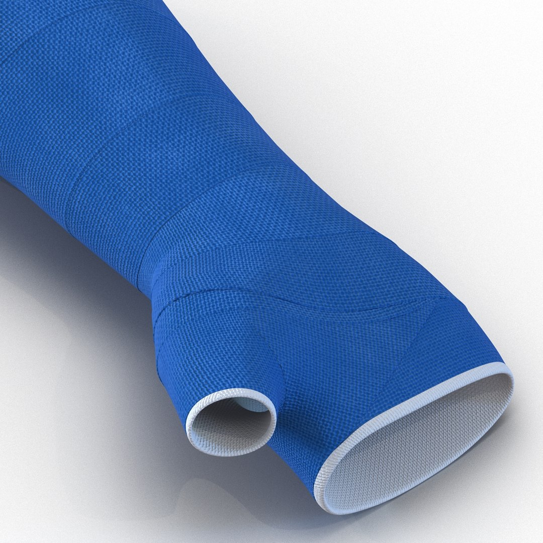 3d blue fiberglass cast arm