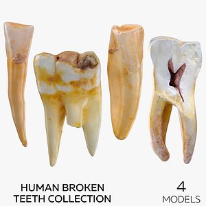 3D Human Broken Teeth Collection - 4 models