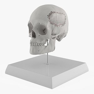 Display Skull with Fixed Cranial Mesh Implant