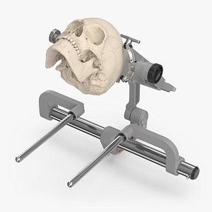 3D Neurosurgical Cranial Fixation Device with Skull model