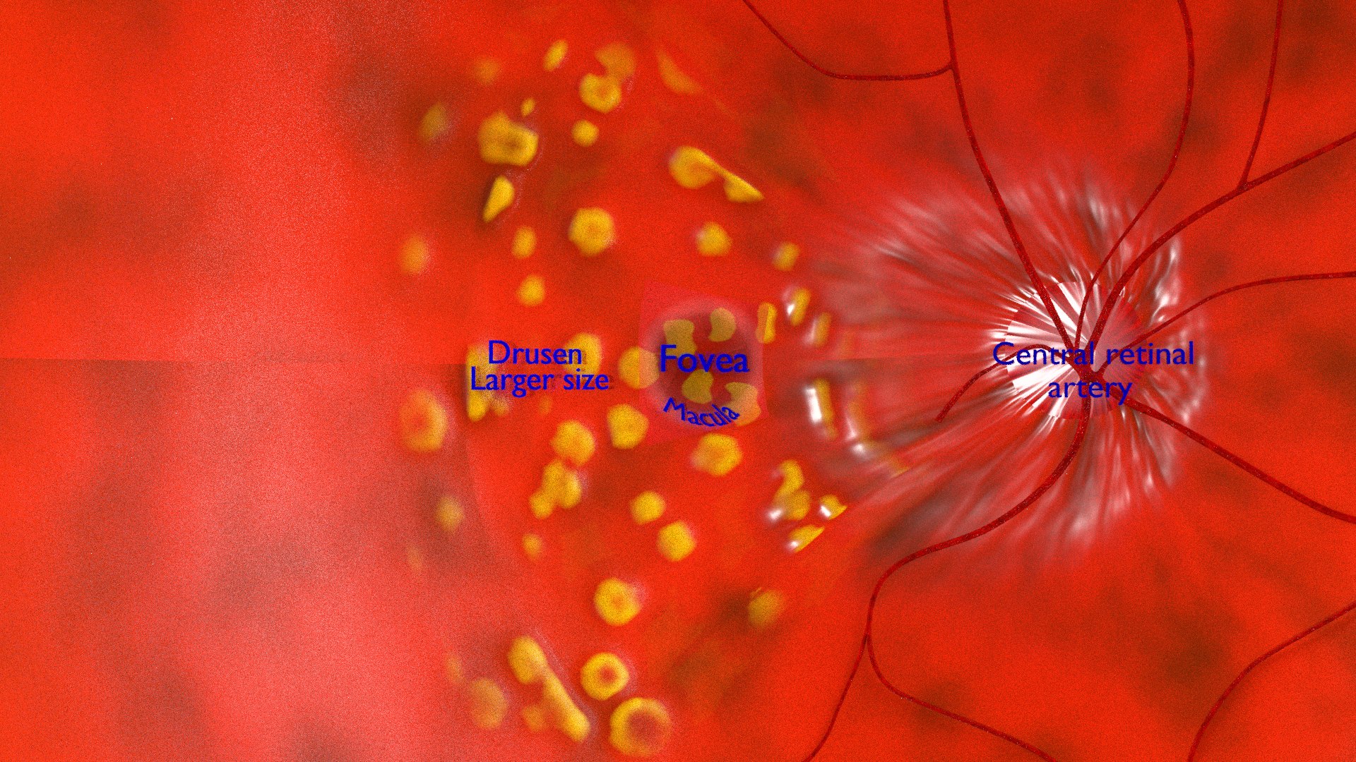 Age-related Macular Degeneration AMD ARMD Detailed Labelled Animated ...