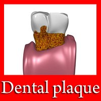 Tooth with Dental Plaque