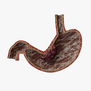 Human Stomach Cross Section with Carcinoma 3D